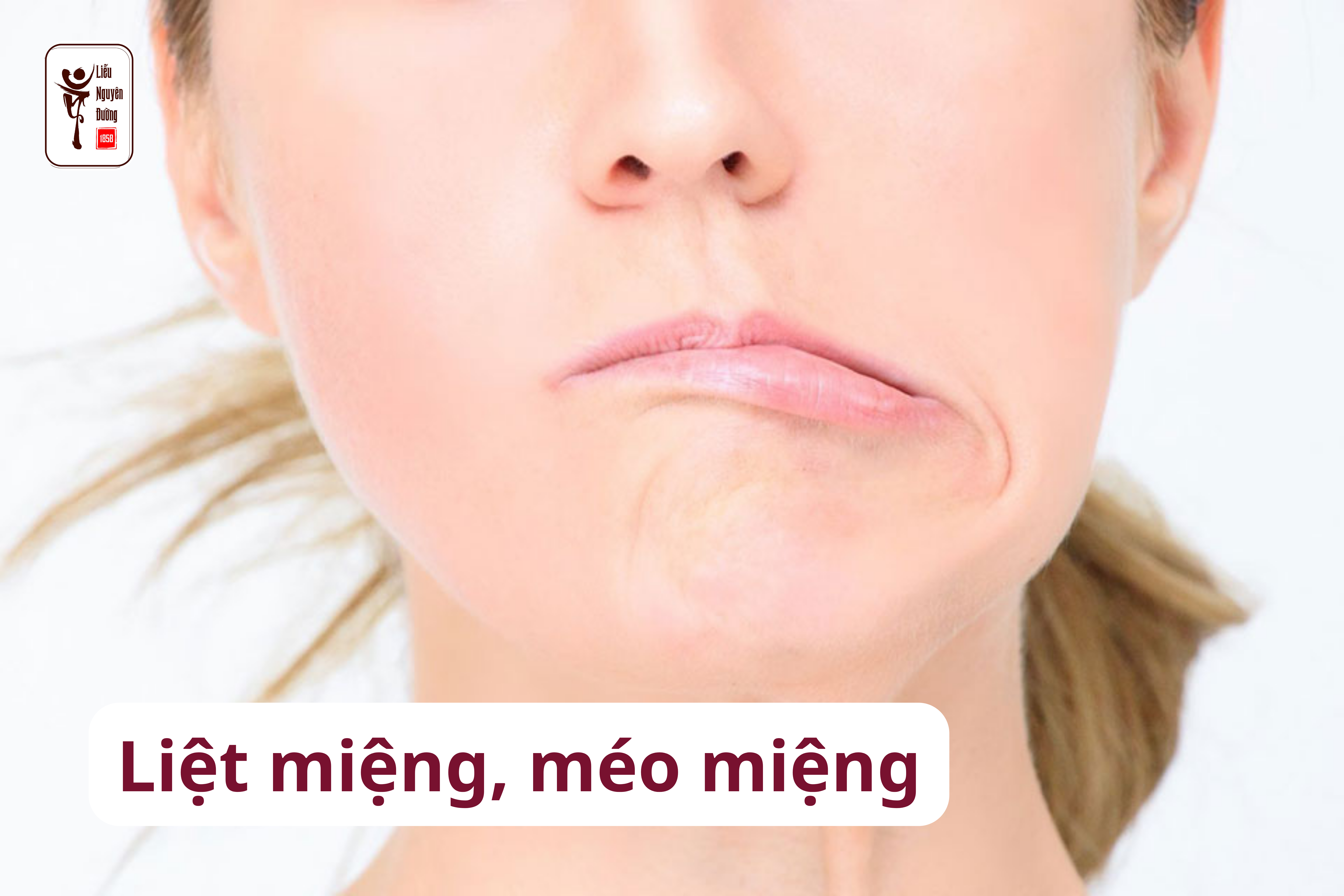 Liệt miệng, méo miệng - nguy cơ bệnh tiềm ẩn