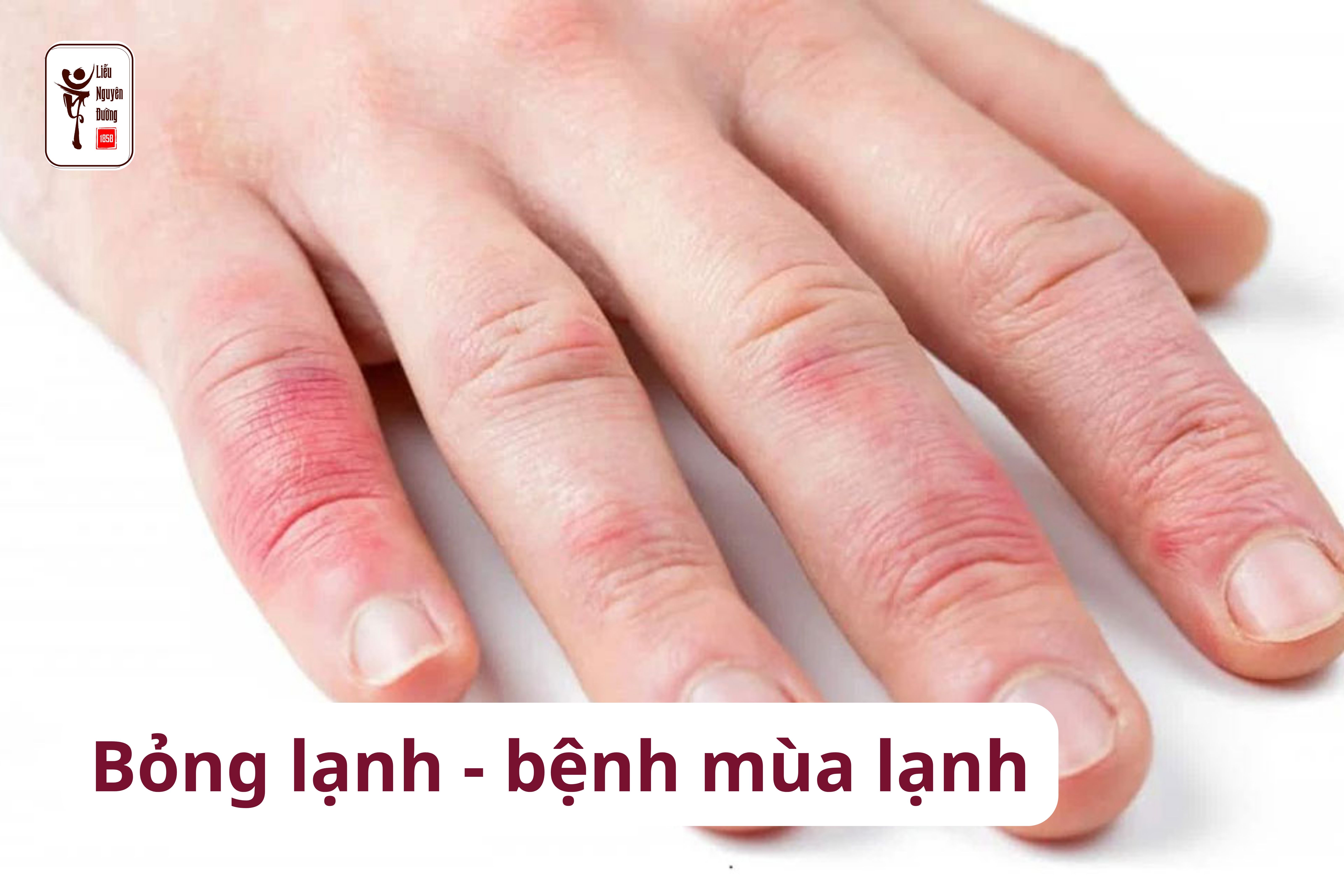 Tình trạng sưng phỏng, bỏng tay do thời tiết lạnh rét